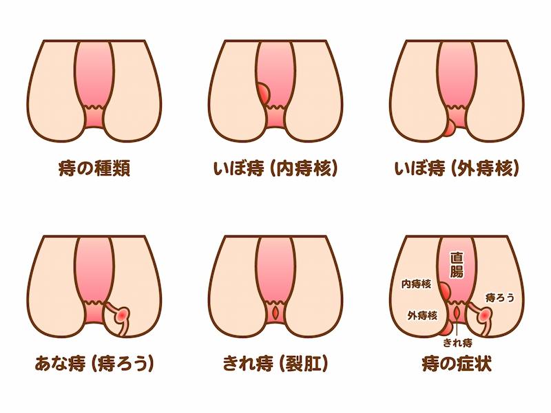 痔の種類のイラスト